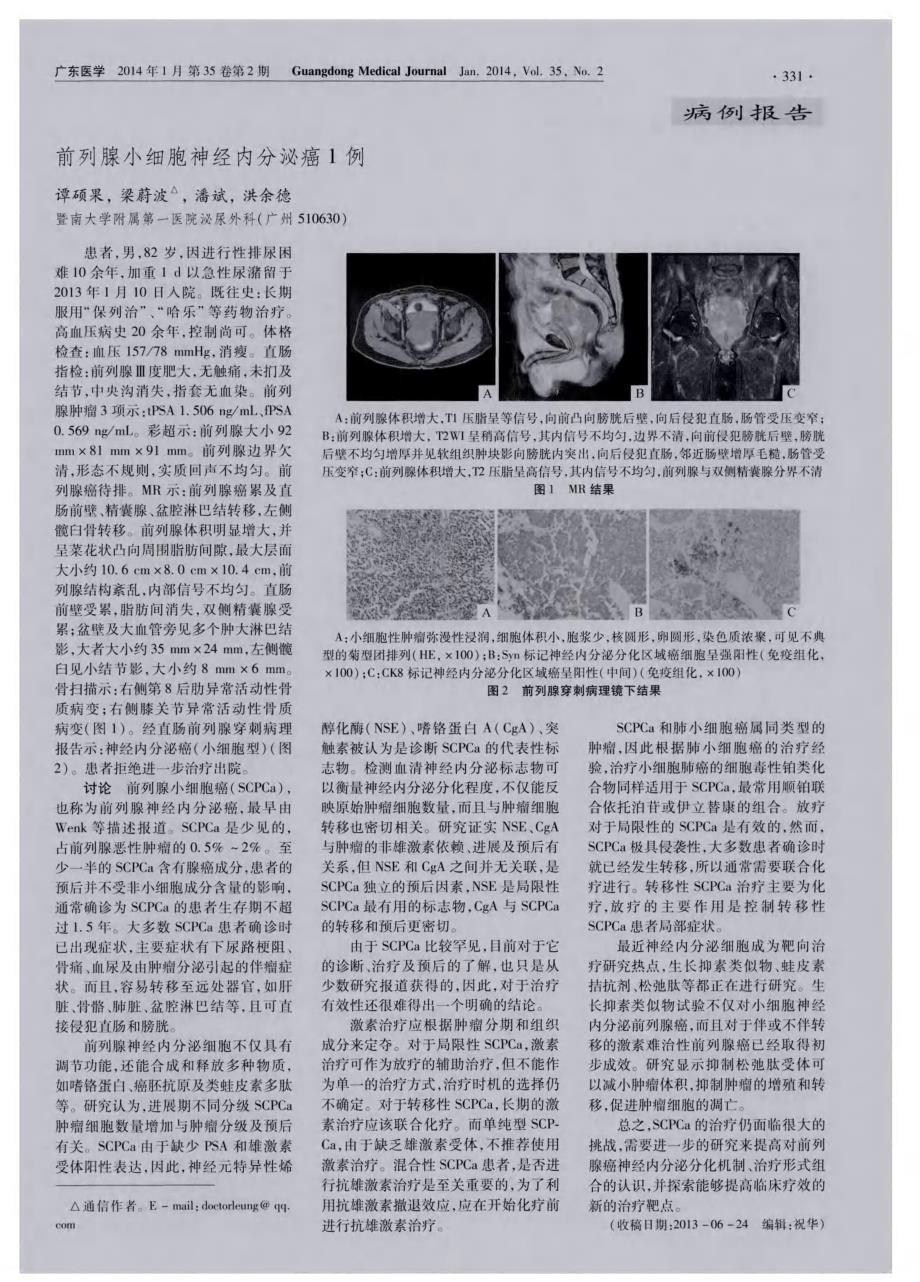 前列腺小细胞神经内分泌癌1例 (论文)_第1页