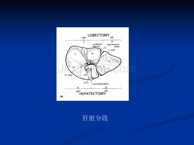 肝切除的并发症_第3页