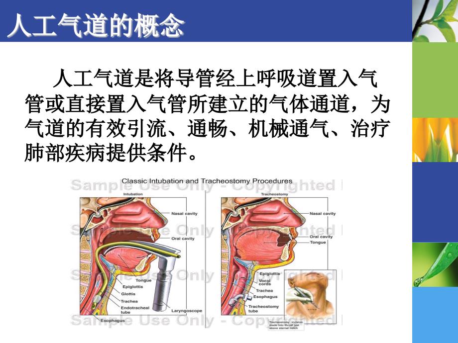 人工气道的建立一_第2页