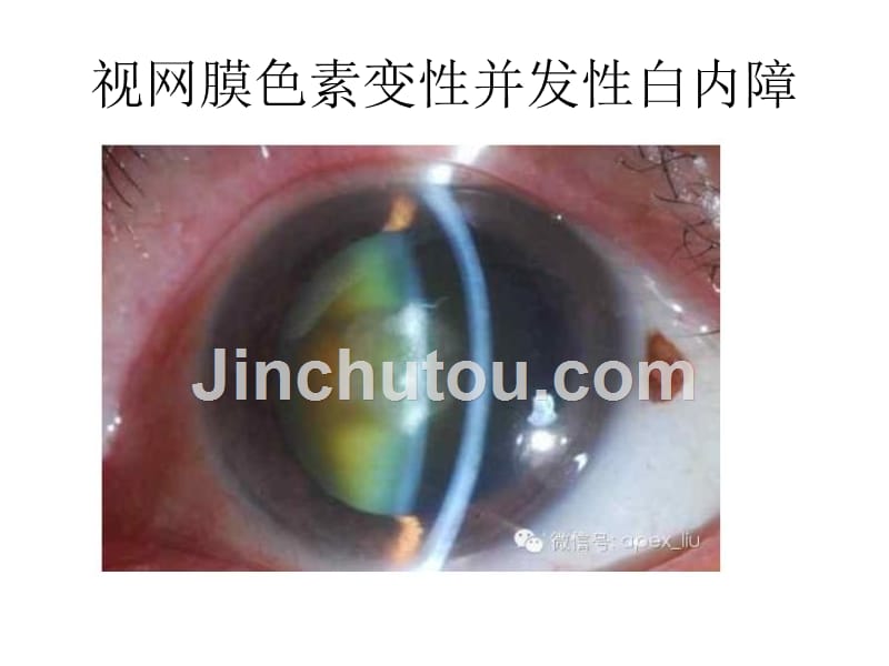 视网膜色素变性并发性白内障12_第1页