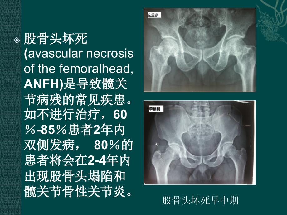 羟基磷灰石减压棒治疗股骨头坏死及股骨颈骨折_第3页