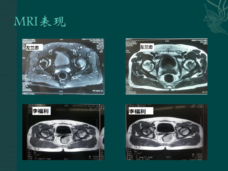 羟基磷灰石减压棒治疗股骨头坏死及股骨颈骨折_第4页