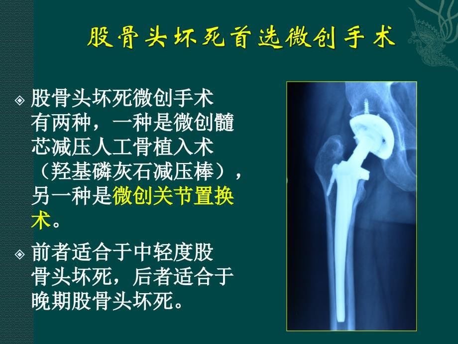 羟基磷灰石减压棒治疗股骨头坏死及股骨颈骨折_第5页