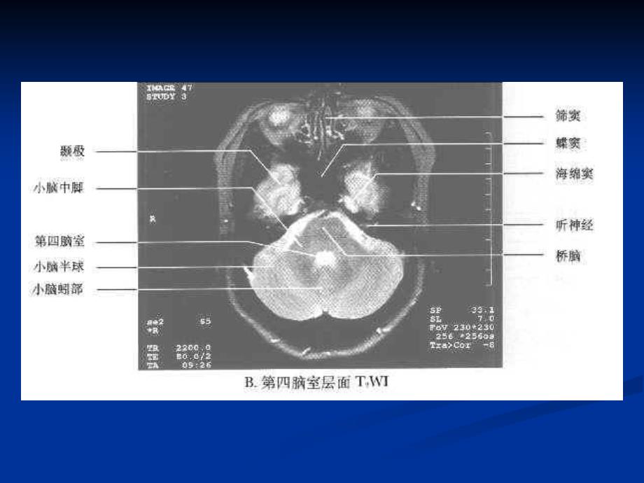 枢神经系统常见肿瘤的MRI诊断_第3页