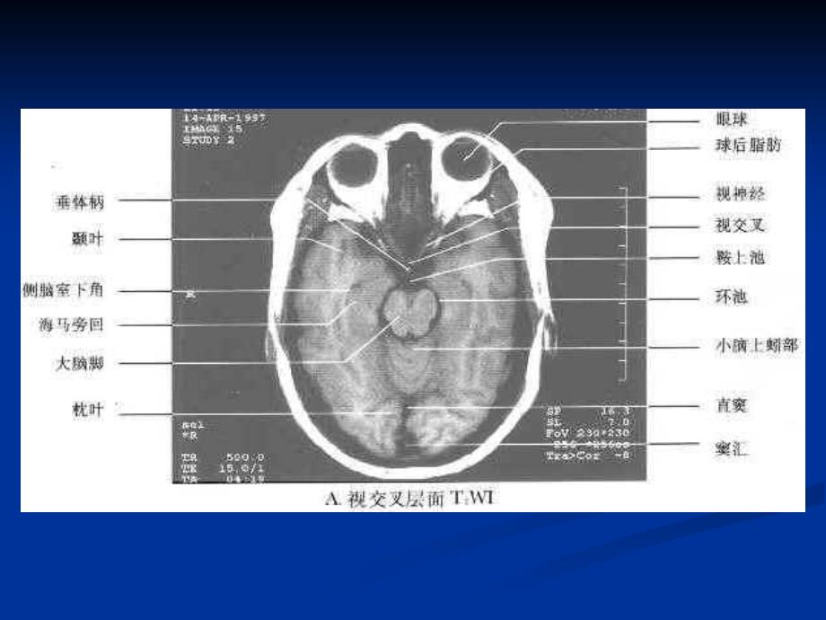 枢神经系统常见肿瘤的MRI诊断_第4页