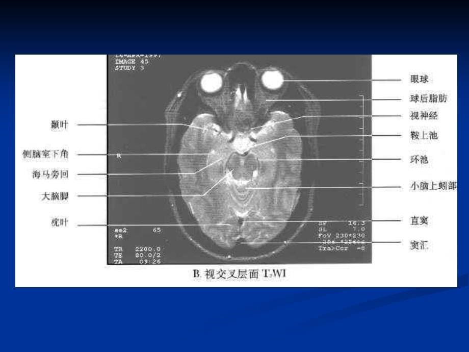 枢神经系统常见肿瘤的MRI诊断_第5页