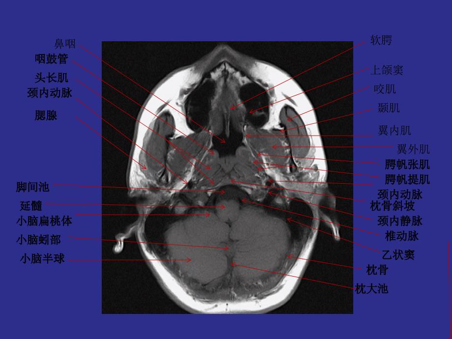 鼻咽部详细MRI断层图谱_第2页