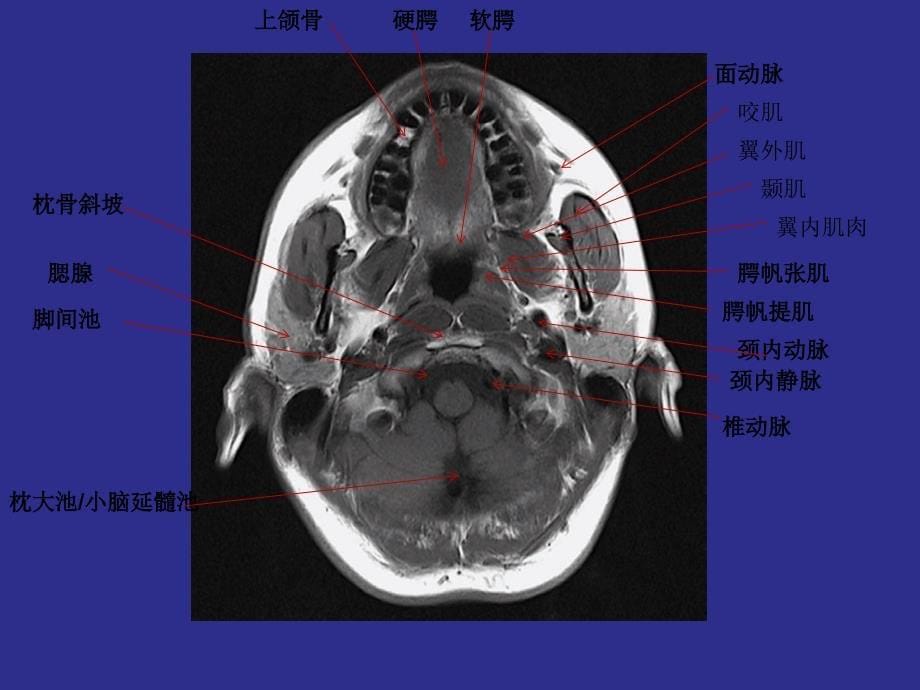 鼻咽部详细MRI断层图谱_第5页