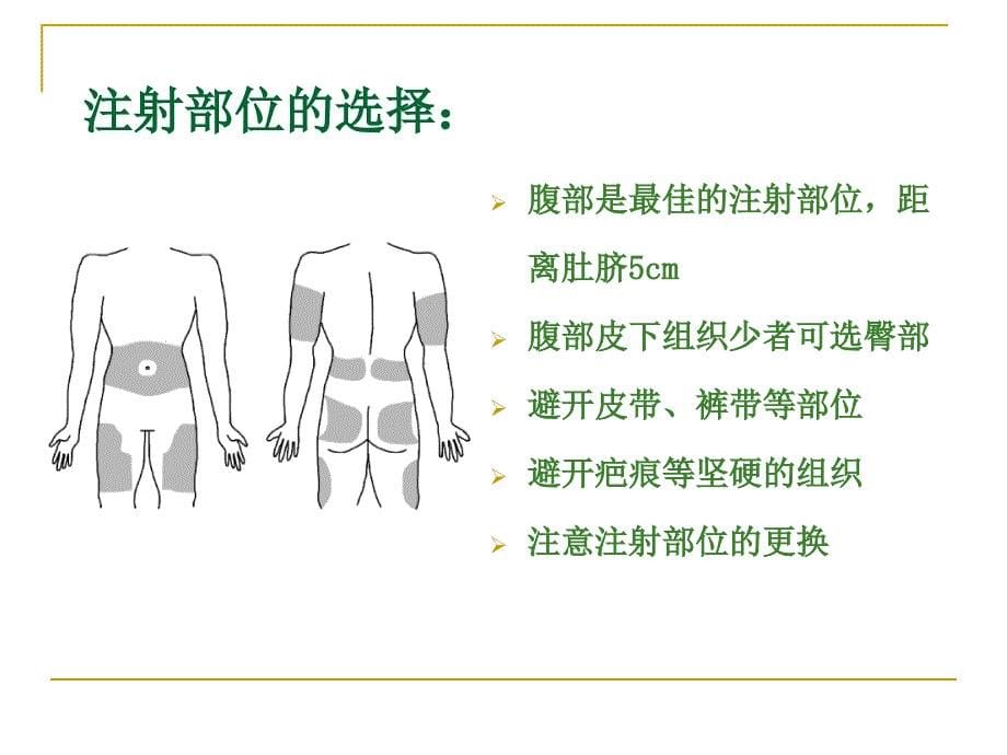 胰岛素泵的操作演练_第5页