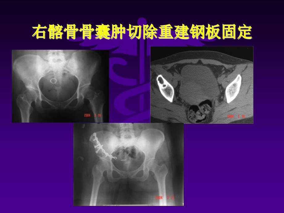 骨盆肿瘤切除术后骨盆环重建策略3_第5页