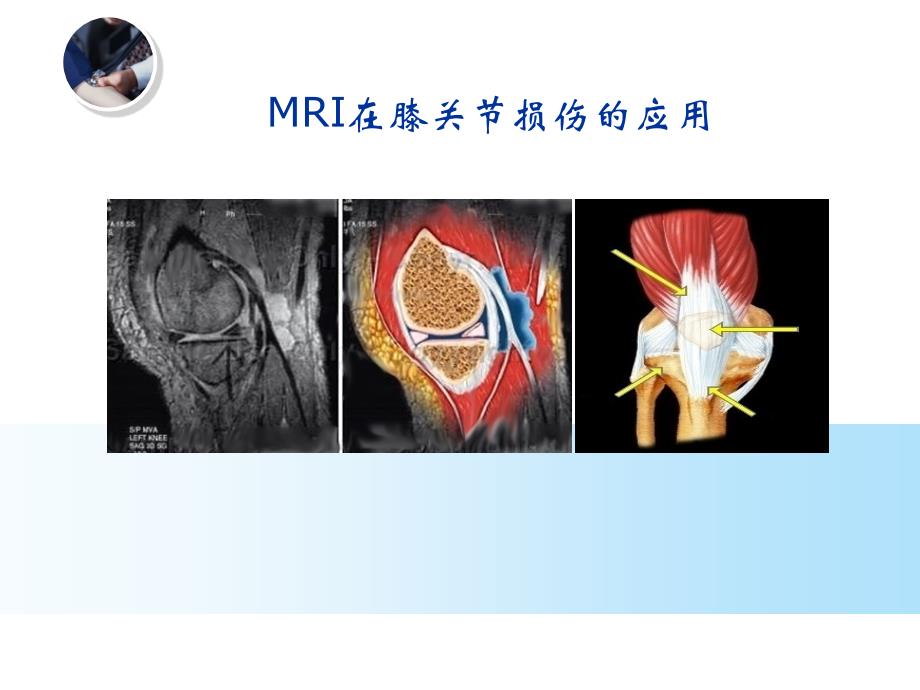 MRI在膝关节损伤的应用_第1页