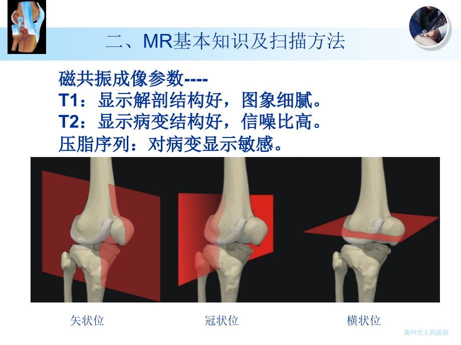 MRI在膝关节损伤的应用_第4页