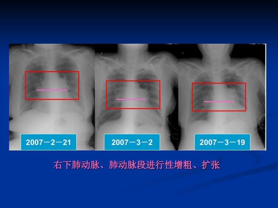 07-3-17-肺栓塞影像学诊断-北京讲座-1_第5页