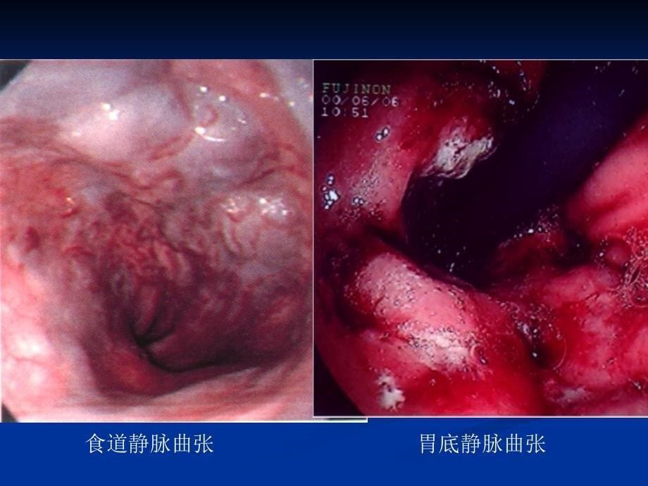 血液透析远期并发症：上消化道出血_第5页