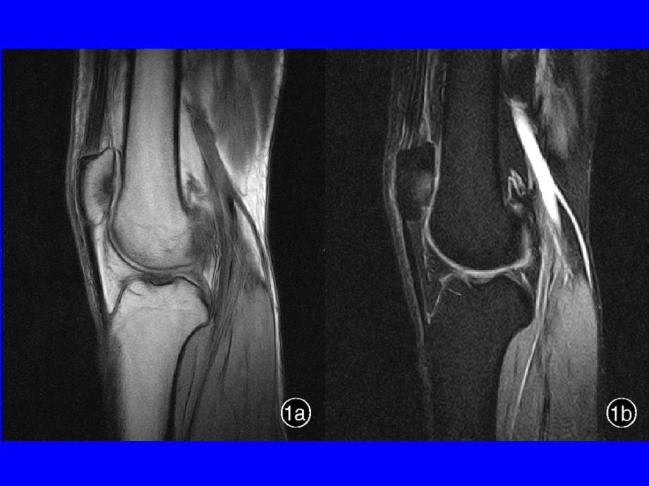 MRI在骨关节中的诊断价值_第5页