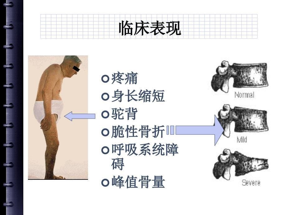 骨质疏松症的理论_第5页