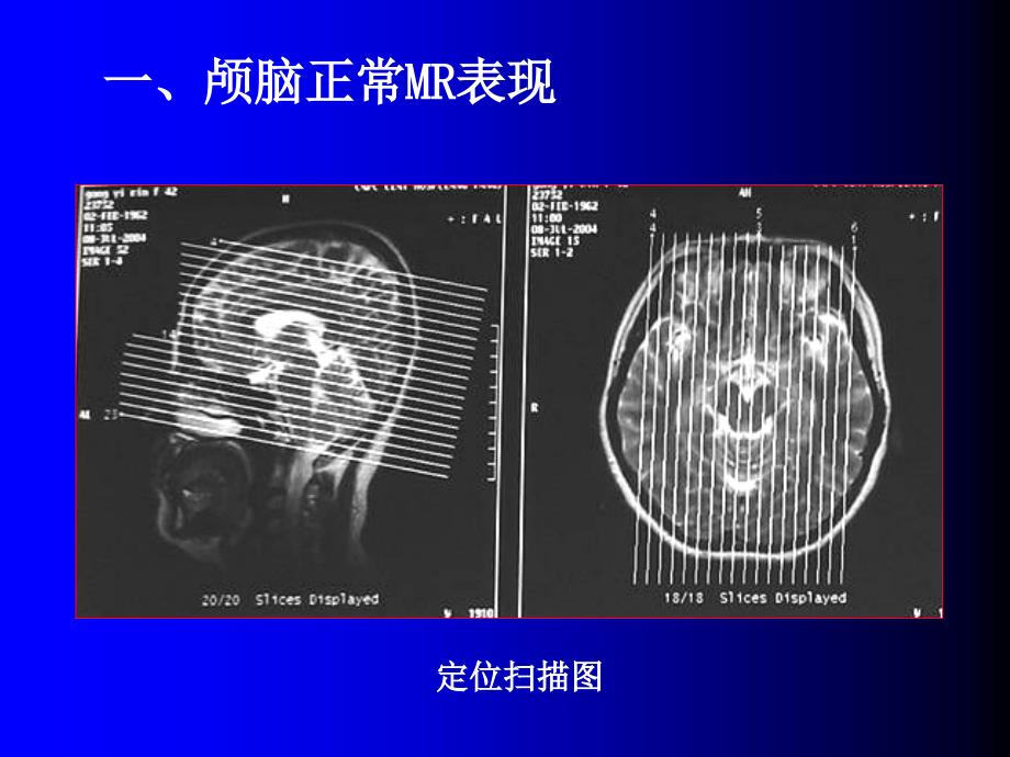 磁共振成像2脑部常见疾病-2015_第4页