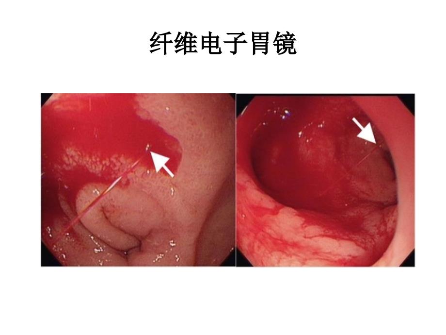 冠心病伴消化性溃疡的抗血小板治疗_第4页