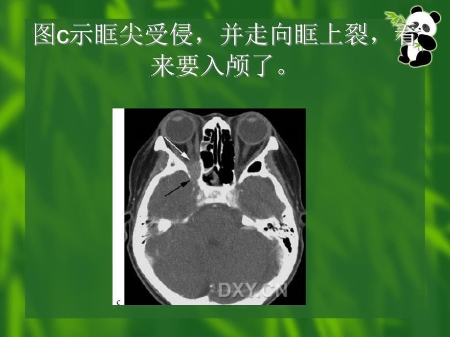 肿瘤影像与放疗之头颈鼻咽癌_第5页