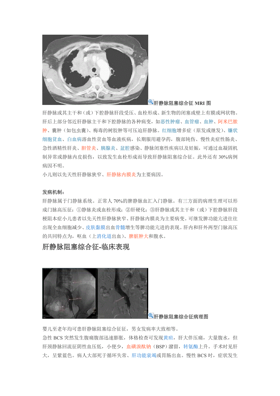 布加综合征诊治lj_第3页