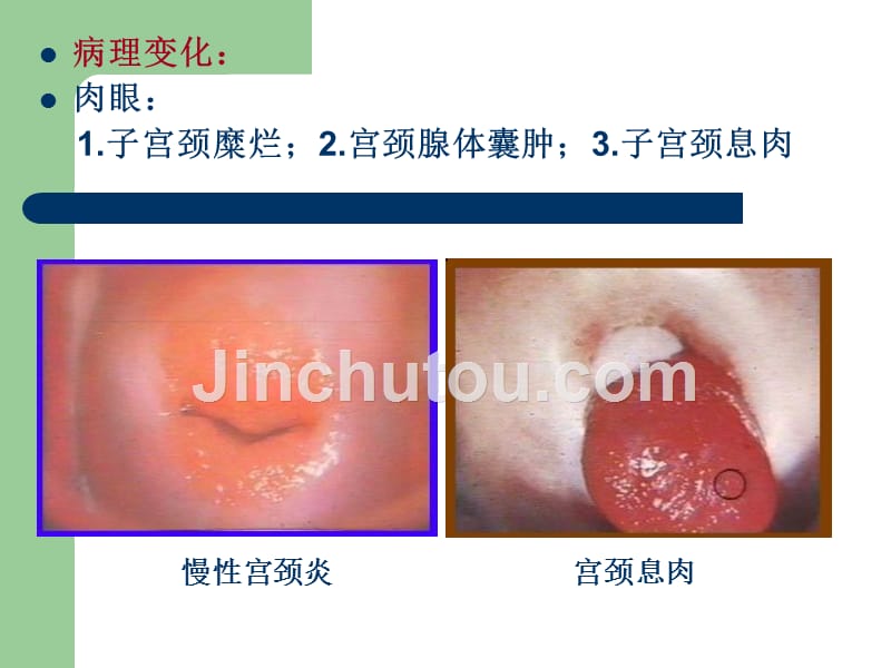 郑州大学临床医学病理学课堂病理女性生殖系统疾病_第5页