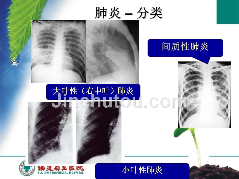 肺炎的诊断和治疗201509岳文香_第2页