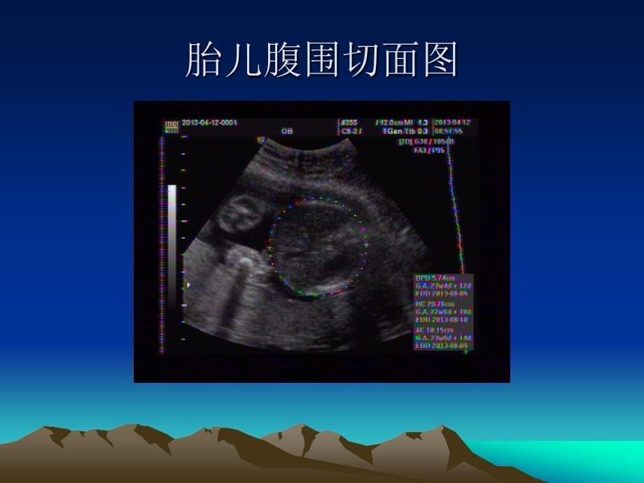 产前胎儿超声微小异常的临床解释_第5页