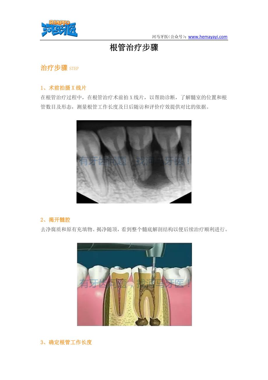 根管治疗步骤_第1页