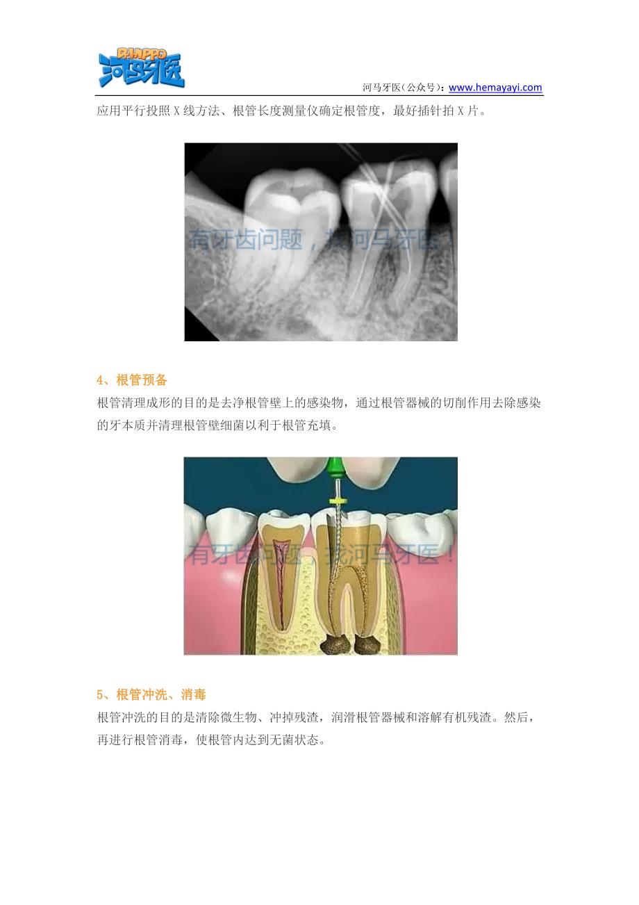 根管治疗步骤_第2页