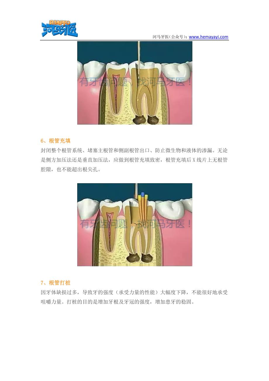 根管治疗步骤_第3页