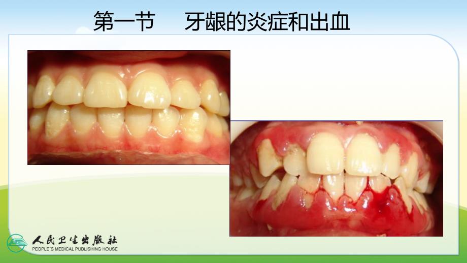 牙周常见疾病_第4页