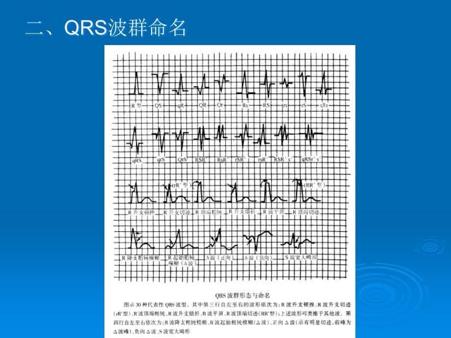 爱爱医资源-心脏疾病的心电图诊断_第5页