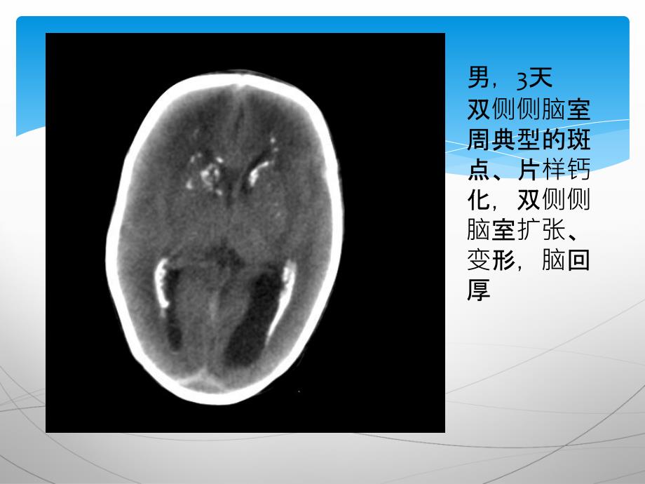 先天性巨细胞病毒感染磁共振波谱研究_第4页