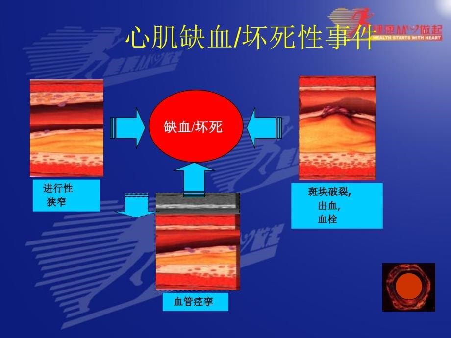 冠心病诊治误区及介入治疗适应证_第5页