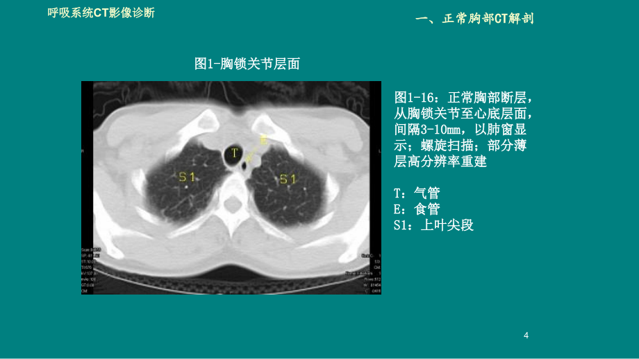 肺部CT解剖诊断鉴别诊断_第4页