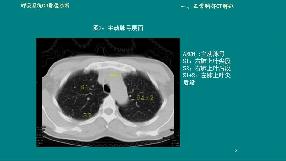 肺部CT解剖诊断鉴别诊断_第5页