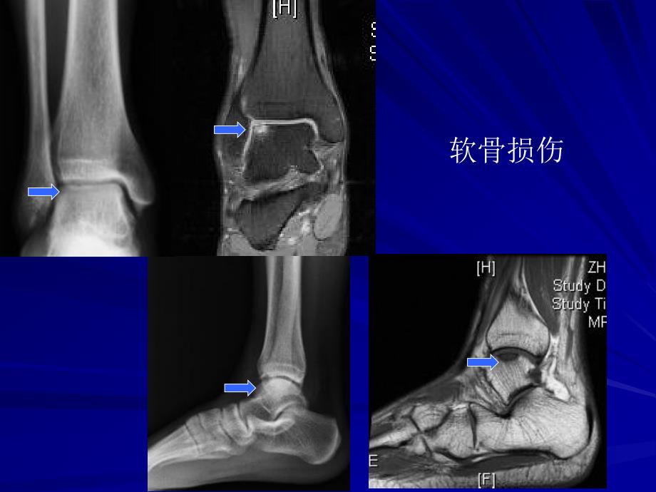 主任-踝关节骨折的多中心研究2011新疆年会_第5页