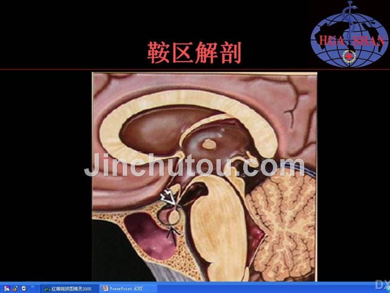 鞍区病变影像诊断上1_第4页