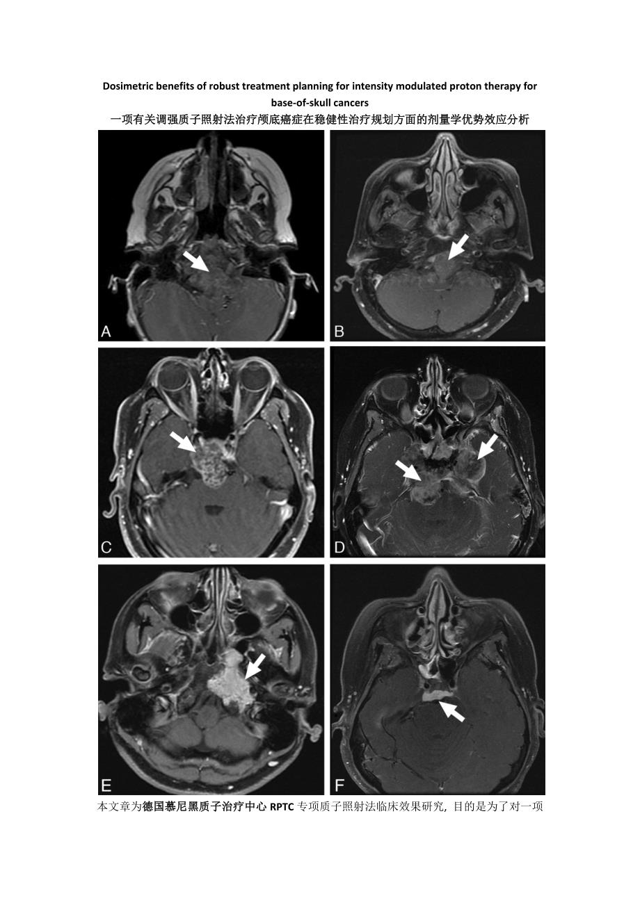 一项有关调强质子照射法治疗颅底癌症在稳健性治疗规划方面的剂量学优势效应分析_第1页