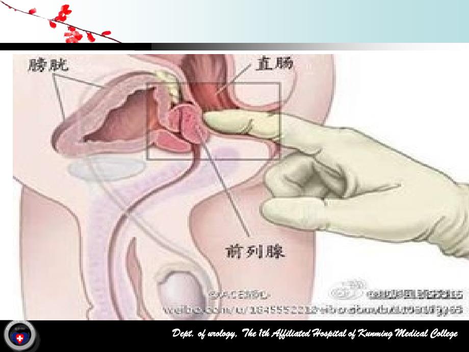 直肠B超引导下经会阴前列腺癌近距离治疗术的手术配合_第3页