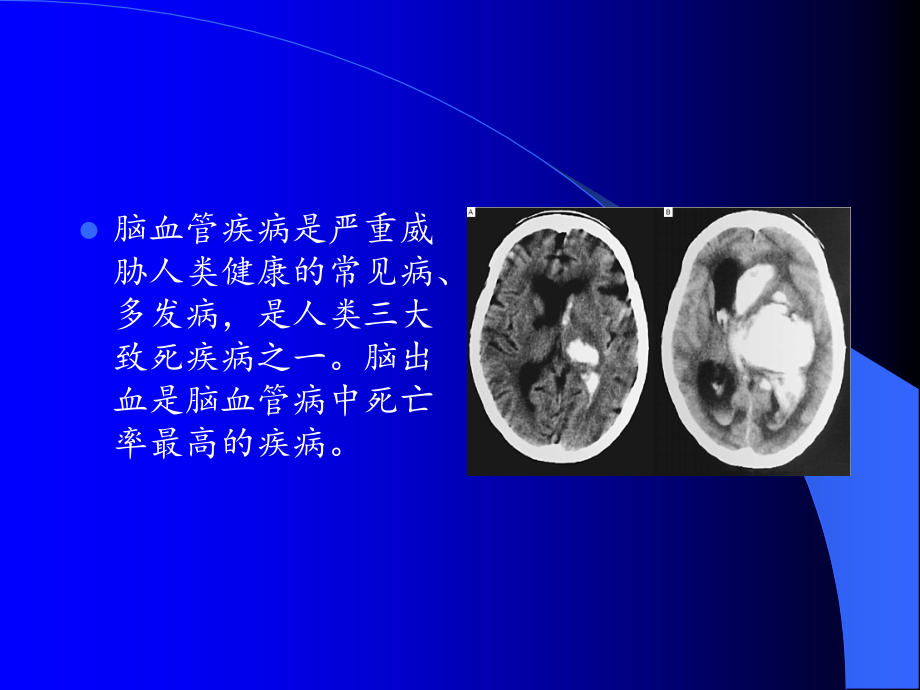 高血压性脑出血的诊断和治疗_第3页