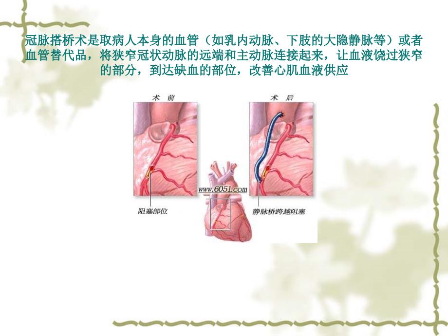 非体循下冠脉搭桥术的麻醉_第2页