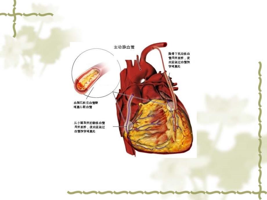 非体循下冠脉搭桥术的麻醉_第3页