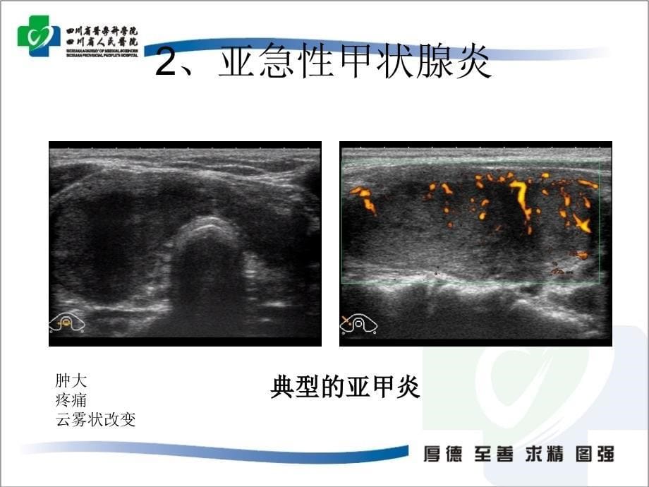 超声在甲状腺疾病中的运用_第5页