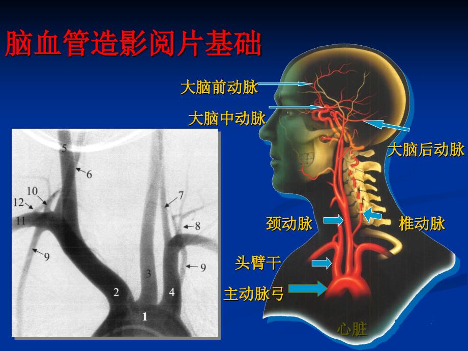 脑血管造影阅片_第1页