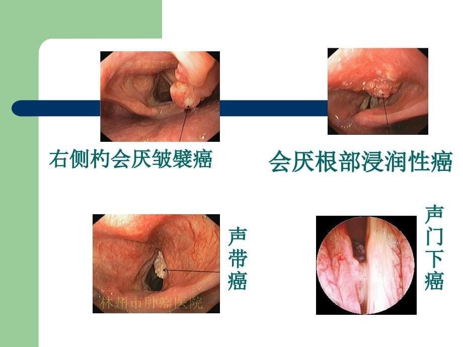 喉癌术后并发症_第5页