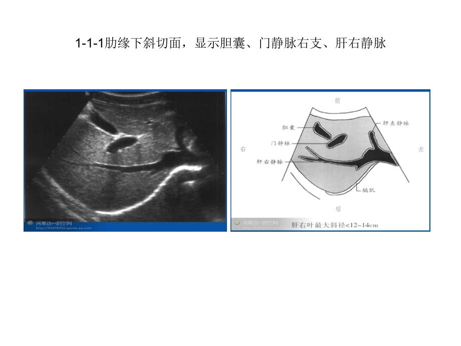 个肝脏超声切面你常用哪_第3页