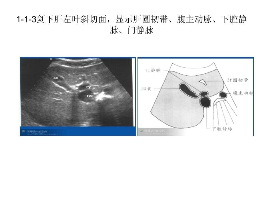 个肝脏超声切面你常用哪_第5页