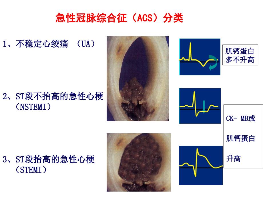 ACS个体化抗血小板治疗_第4页