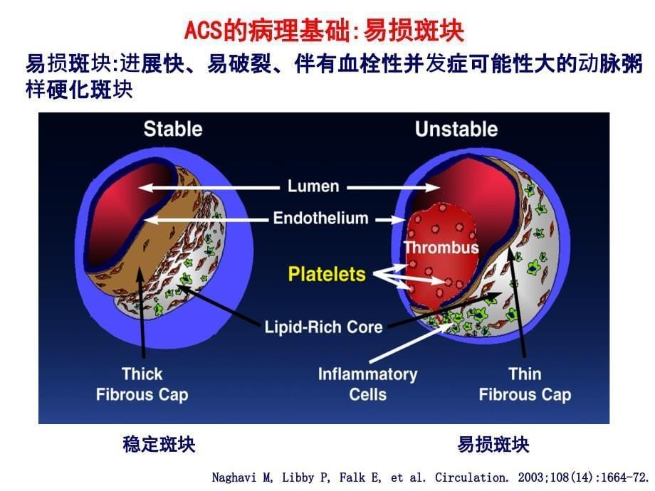 ACS个体化抗血小板治疗_第5页